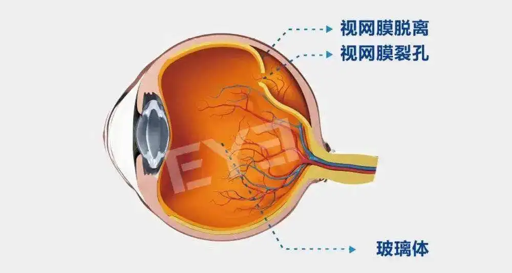 视网膜脱落怎么办,能通过手术恢复吗